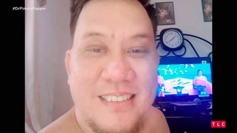 Illustration for article titled Dr. Pimple Popper Removes 68 Lipomas from One Person in Season 2 Premiere